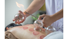 Acupuncture Treatment with Korean Cupping